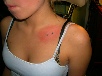 dermal anchors on the collar