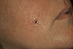 mircodermal in the cheek