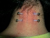surface piercing, nape piercing